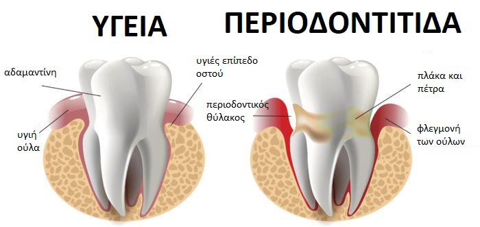 periodontitida-1